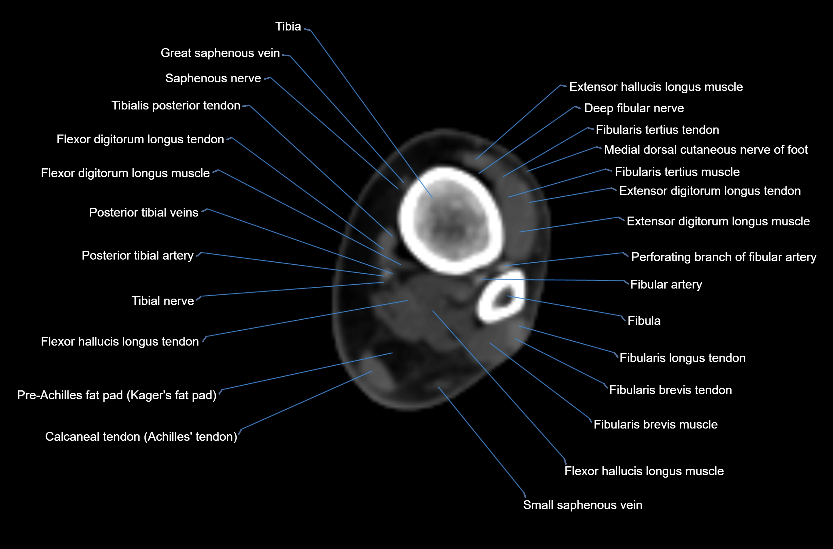 CT Ankle axial cross sectional anatomy labelled image -00018.webp